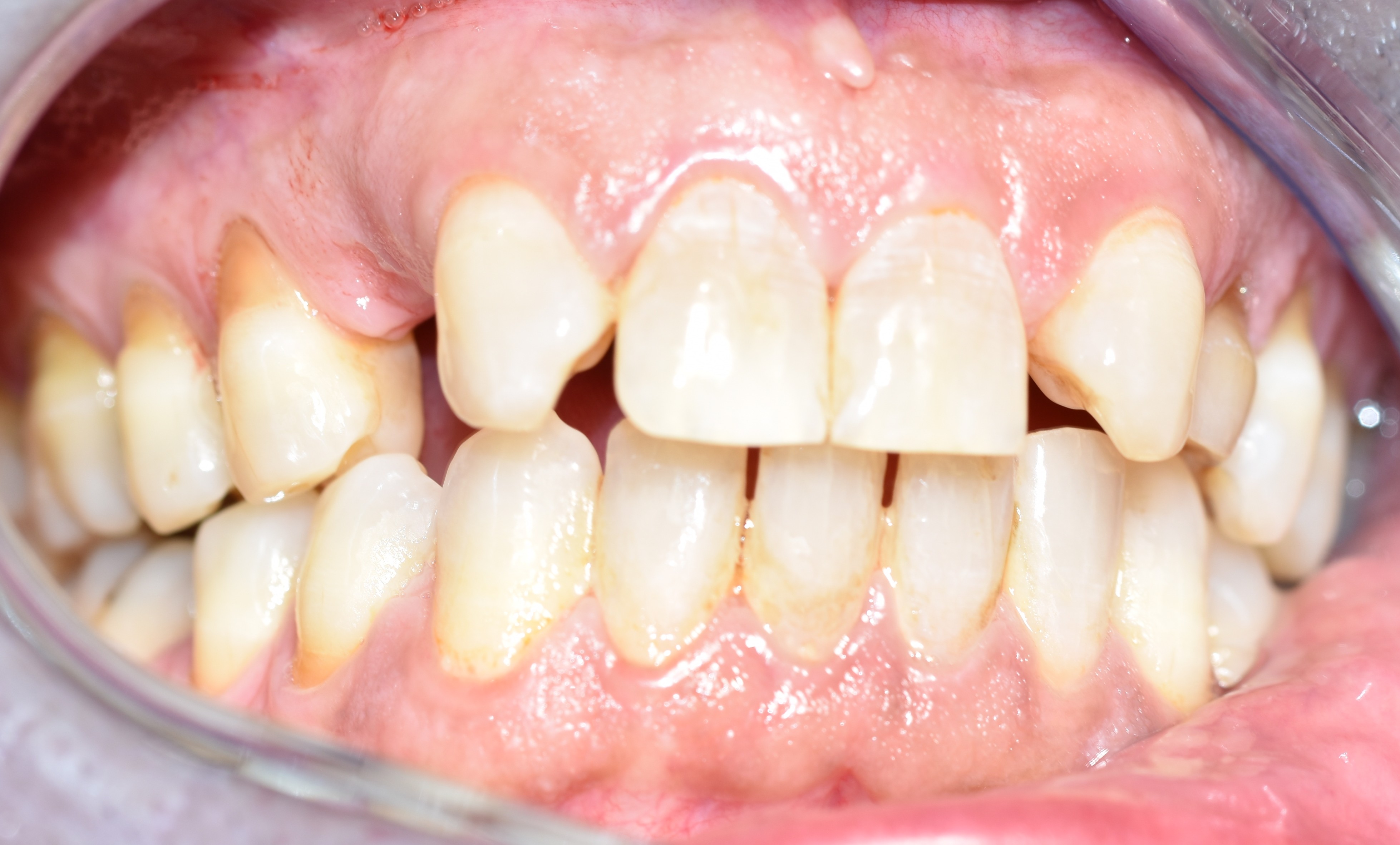 Before treatment